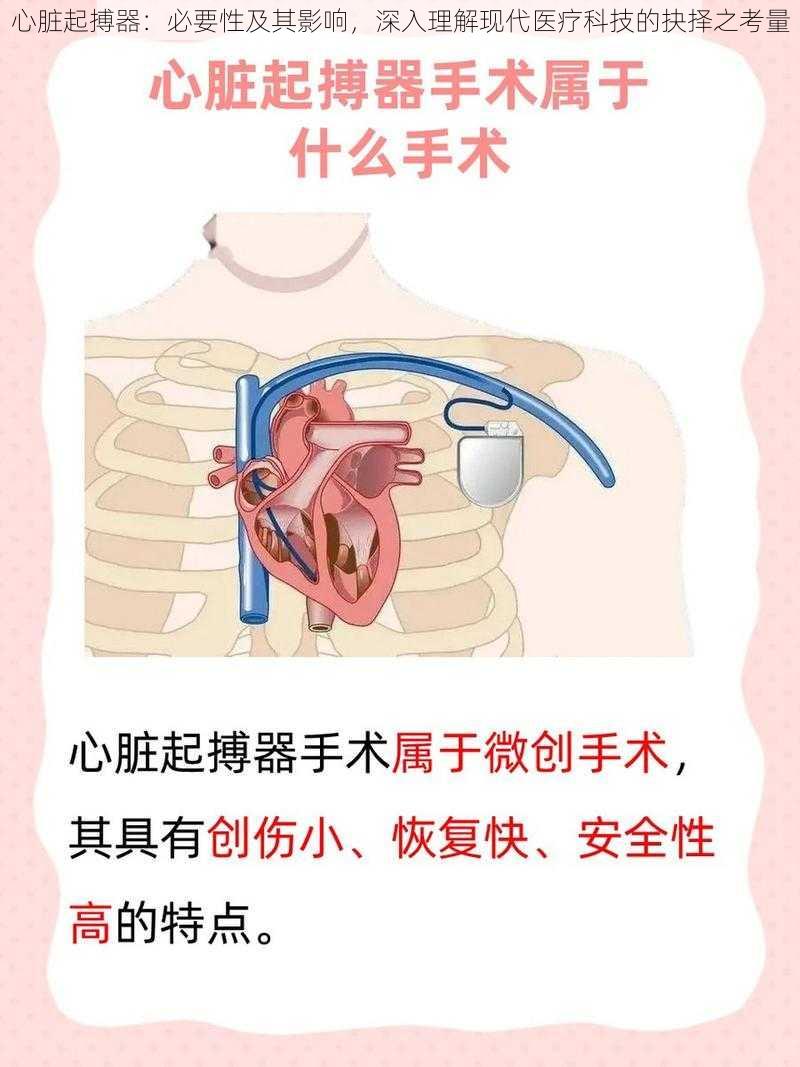 心脏起搏器：必要性及其影响，深入理解现代医疗科技的抉择之考量